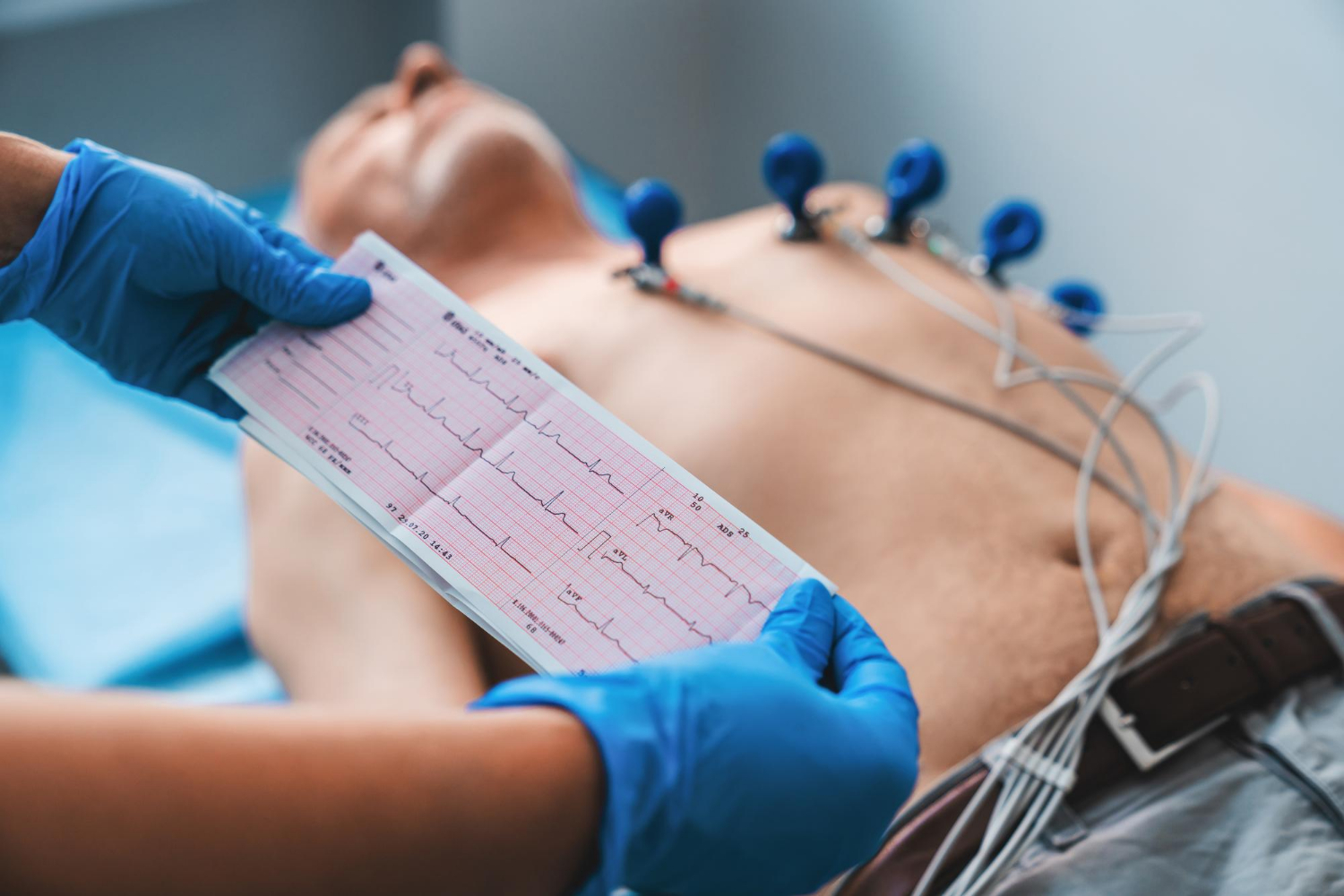 ECG